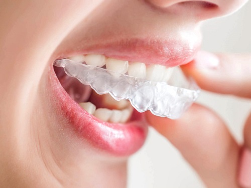 Hàm răng đẹp với phương pháp niềng răng invisalign 1
