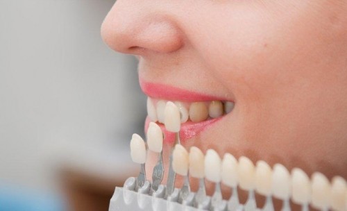 Công nghệ tẩy trắng răng nào nhanh nhất?