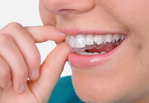 Quy trình tẩy trắng răng bằng máng tẩy trắng 1