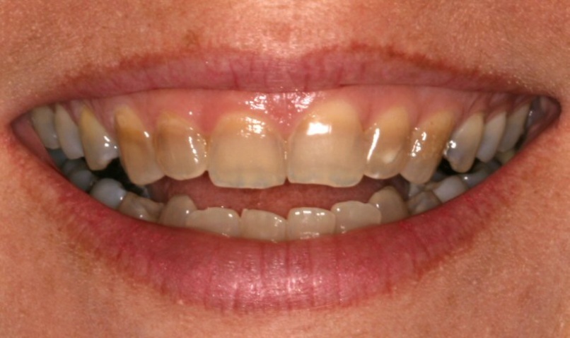 Phương pháp điều trị răng nhiễm Tetracycline tốt nhất?