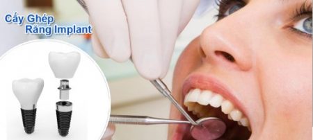 Địa chỉ trồng răng implant tốt nhất ở đâu?