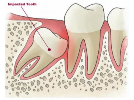 Làm gì khi răng khôn hàm dưới mọc lệch