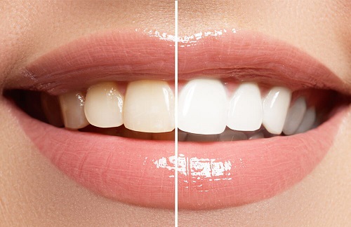 Tác hại của việc tẩy trắng răng bạn nên biết để phòng tránh 1