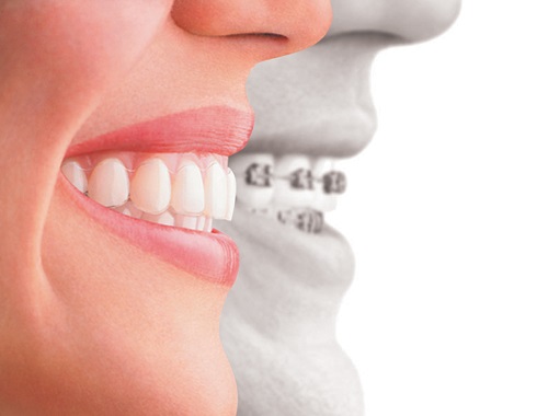 Niềng răng Cần Thơ - Tìm hiểu dịch vụ niềng răng 1