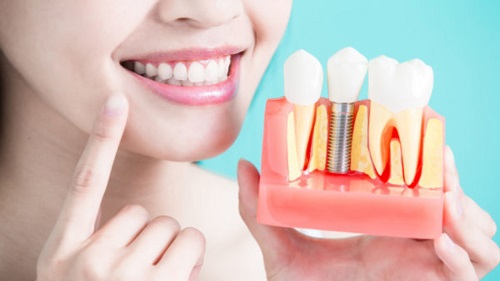Trồng răng kiêng ăn gì giúp răng chắc khỏe hơn? 1