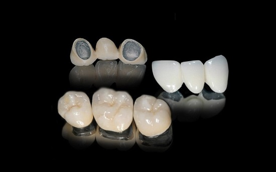 Có nên trồng răng sứ kim loại không? Bạn nên lưu ý gì? 1
